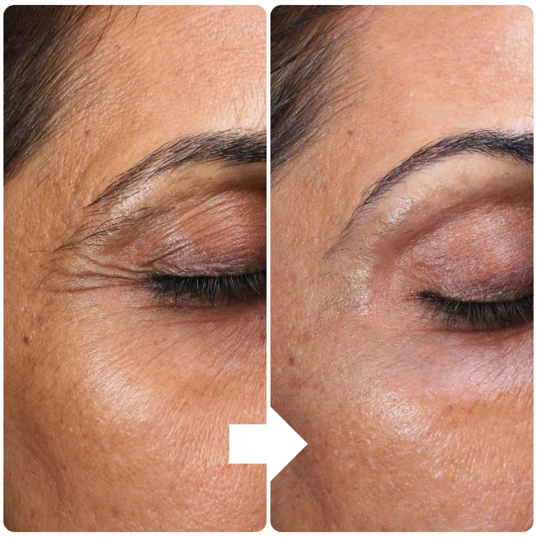 What is Botox