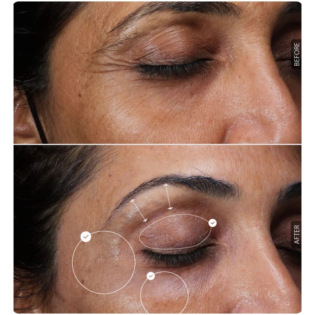 What is ClearLiftTM Laser Facial
