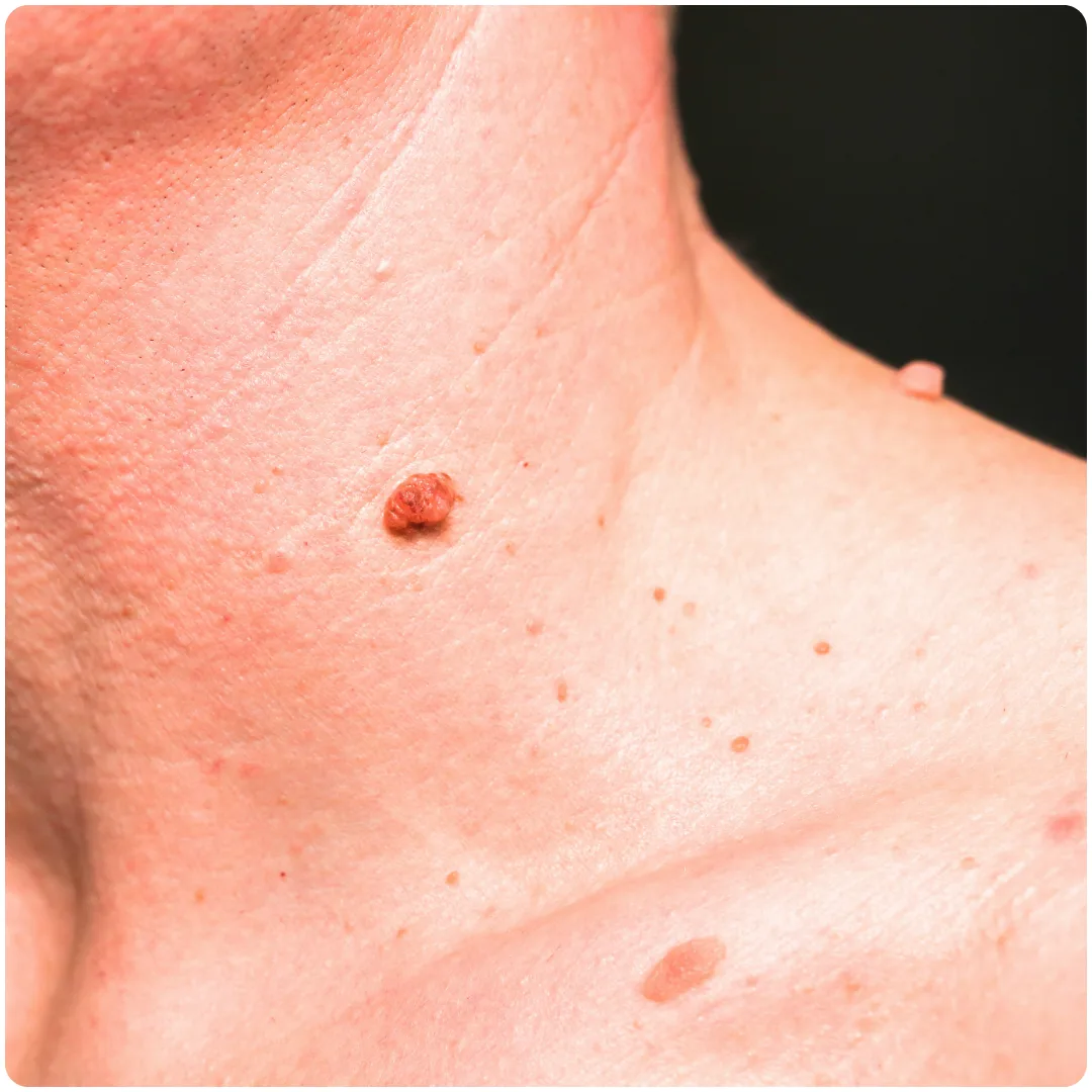 What is Mole