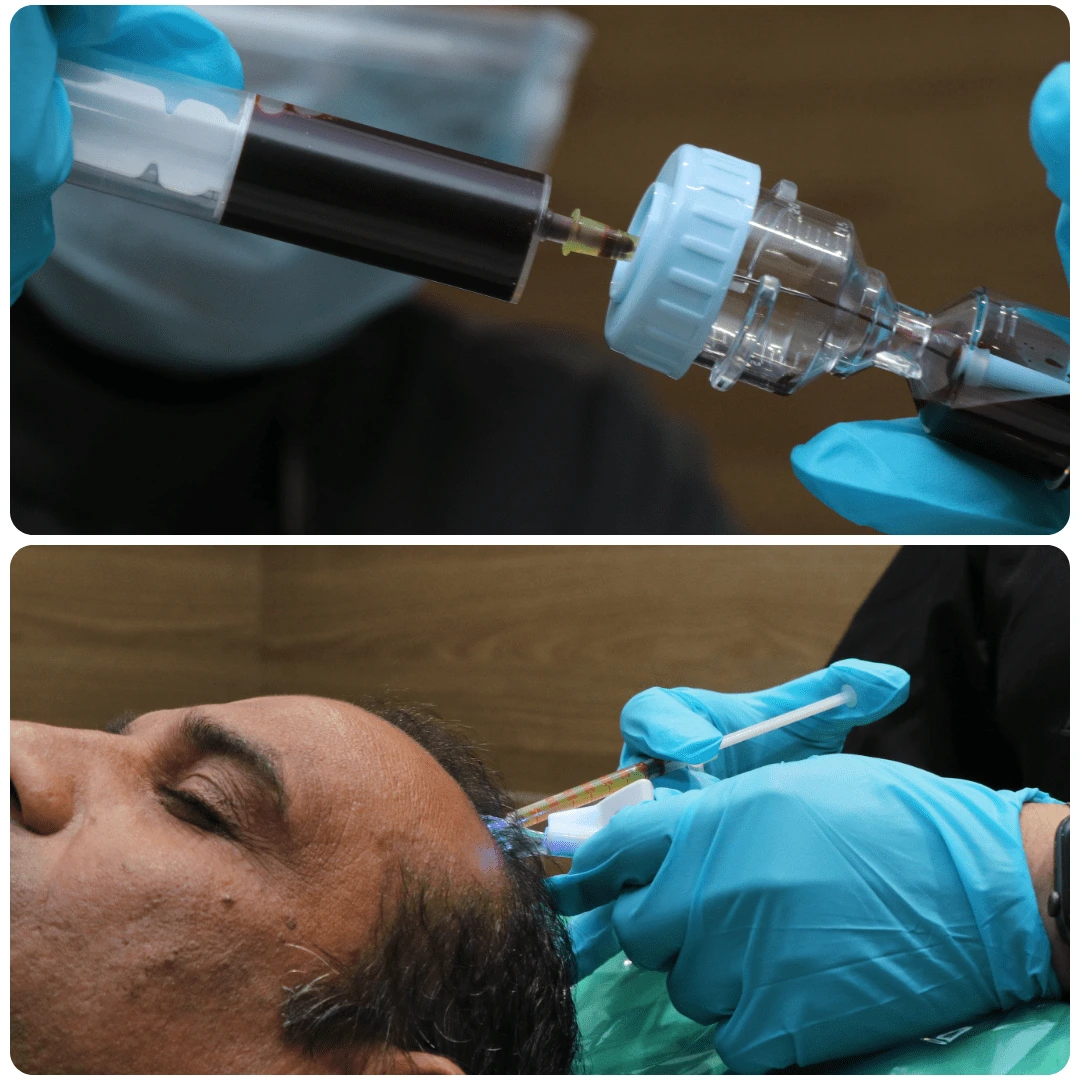 What is Platelet Therapy