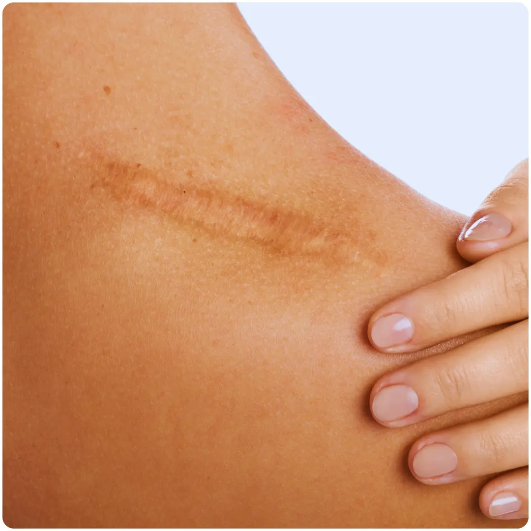 What is Scar Revision