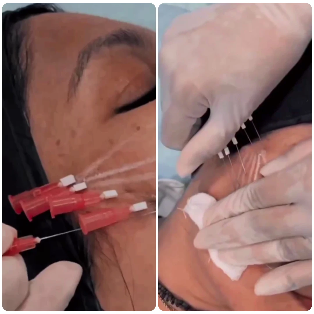 What is Thread Lift