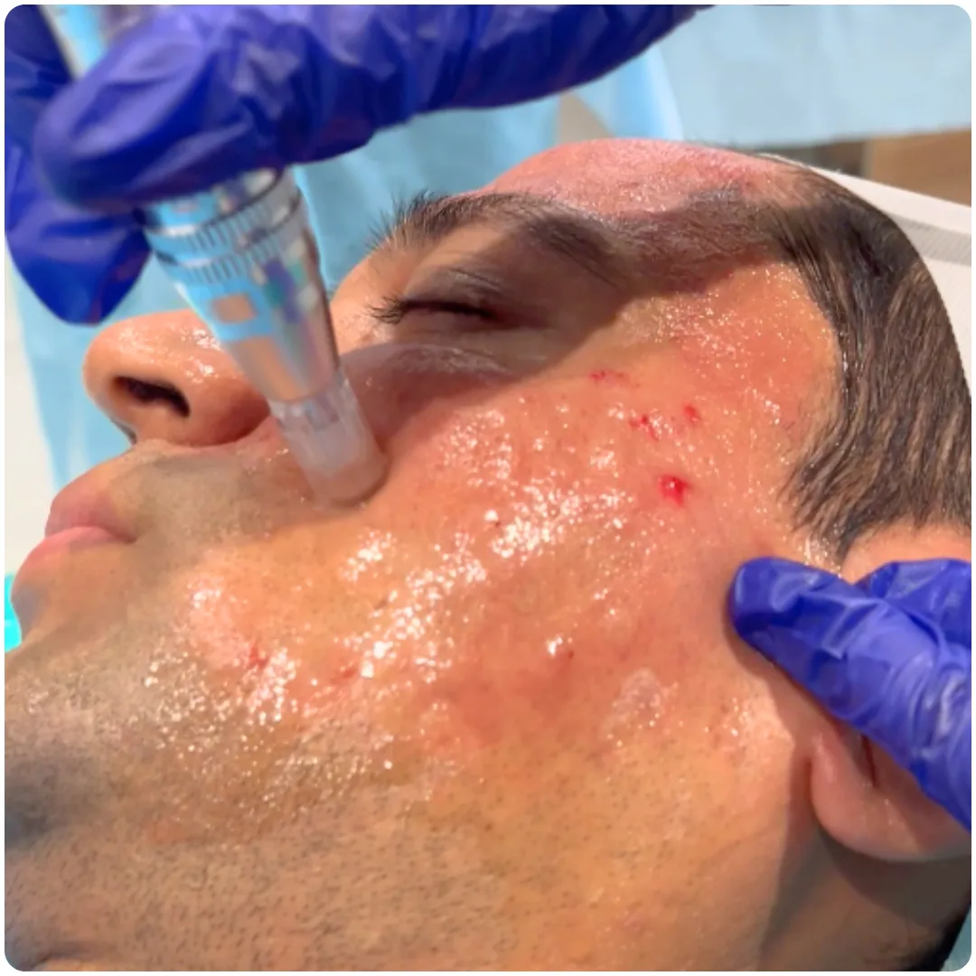 What to expect Liquid Face Lift