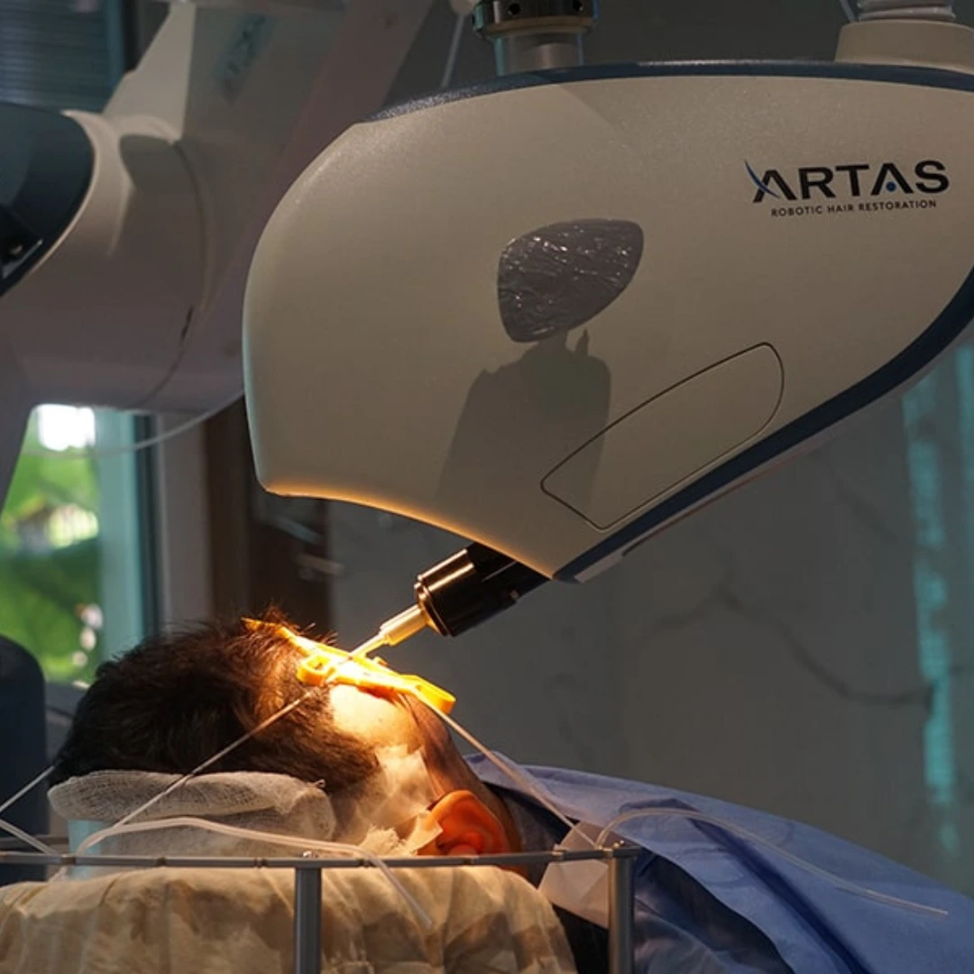 Hair Transplantation