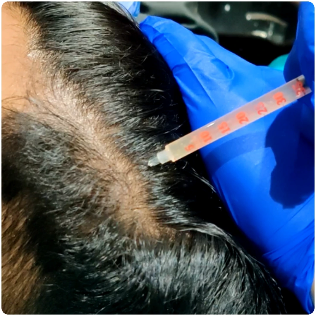 PRP Treatment (2)
