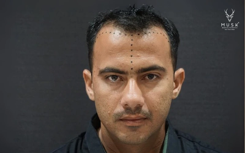 Before Hair Transplant