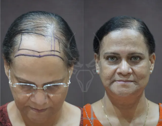 Before After Female Hair Transplant Results