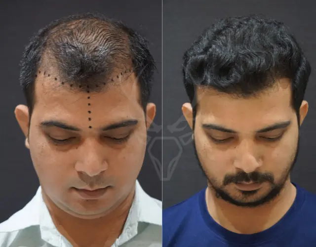 Before After Hair Transplant Results