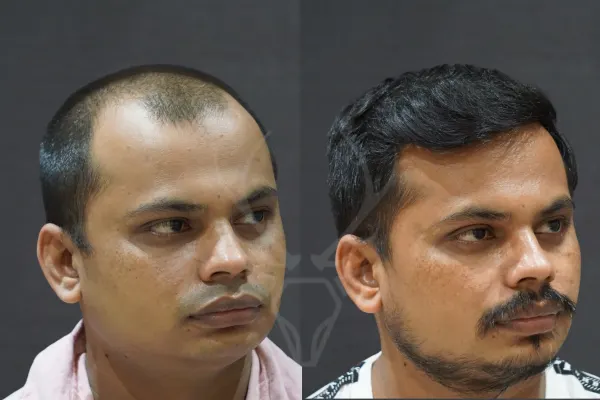 Before After Hair Transplant Results