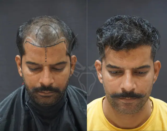 Before After Hair Transplant Results