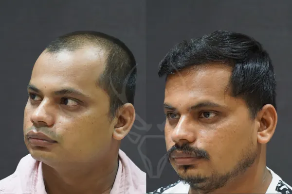 Hair Transplant Before After Results Musk