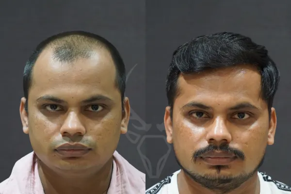 Hair Transplant - Before After Results