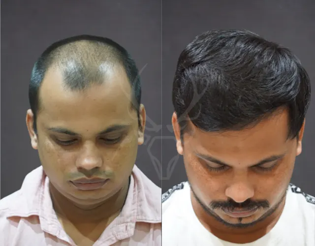 Hair Transplant Results - Ahmedabad India