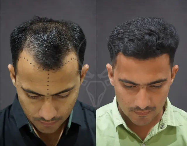 Hair Transplant Results - Before After 10