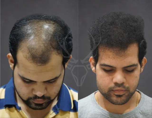Hair Transplant Results - Before After 9