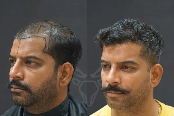 Hair Transplant Results - Before After