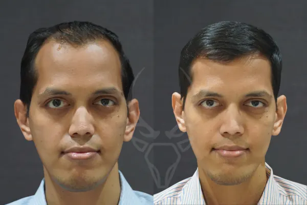 Musk Before - After Results 8 (Centre)