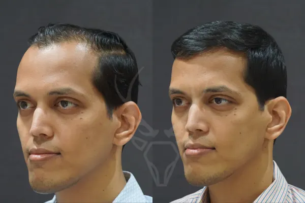 Musk Before - After Results 8 (Left)