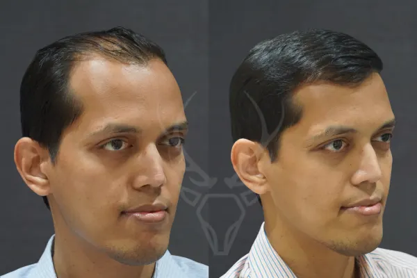 Musk Before - After Results 8 (Right)