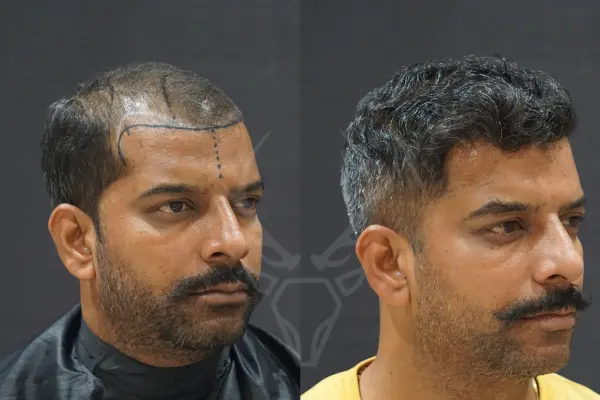 Musk Clinic - Before After Hair Transplant Results