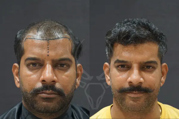 Musk - Hair Transplant Results