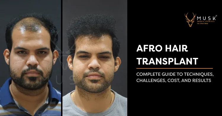 Afro Hair Transplant The Complete 2025 Guide to Techniques, Challenges, Cost, and Results