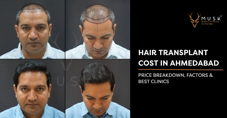Hair Transplant Cost in Ahmedabad Price Breakdown, Factors & Best Clinics