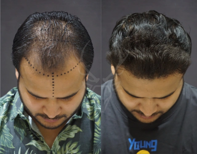 Musk Clinic Hair Transplant Results - Before After Result 16 New