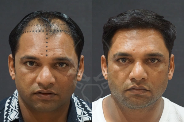 Musk Clinic Hair Transplant Results - Before After Results 22 Centre