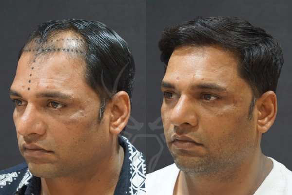 Musk Clinic Hair Transplant Results - Before After Results 22 Right