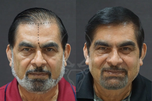 Musk Clinic Hair Transplant Results - Before After Results 23 Centre