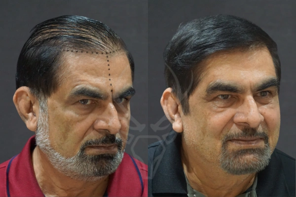 Hair Transplant Cost in Kolkata | Musk Clinic