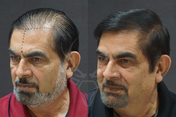 Musk Clinic Hair Transplant Results - Before After Results 23 Right