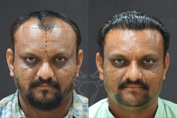 Musk Clinic Hair Transplant Results - Before After Results 24 Centre
