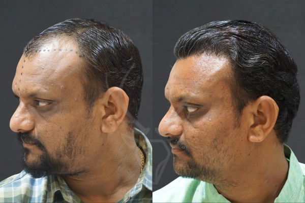 Musk Clinic Hair Transplant Results - Before After Results 24 Right
