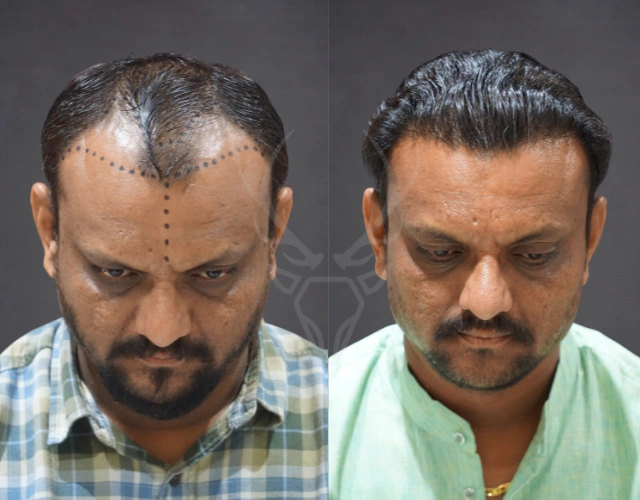 Musk Clinic Hair Transplant Results - Before After Results 24