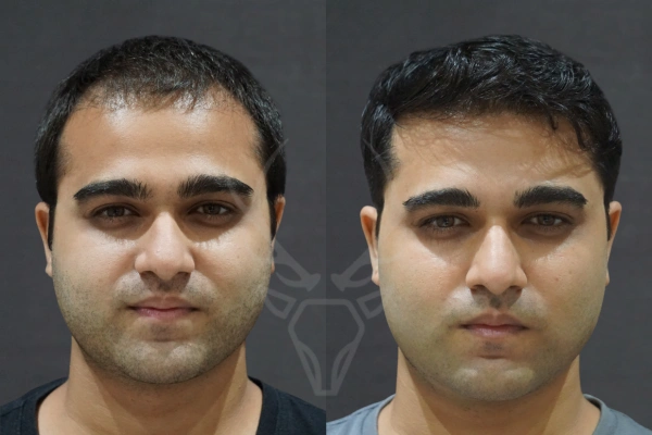 Musk Clinic Hair Transplant Results - Before After Results 25 Centre