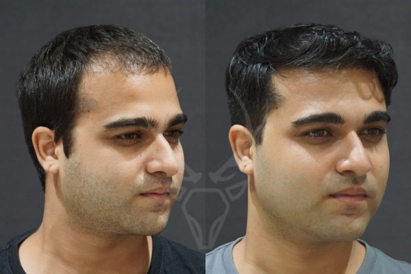 Musk Clinic Hair Transplant Results - Before After Results 25 Left