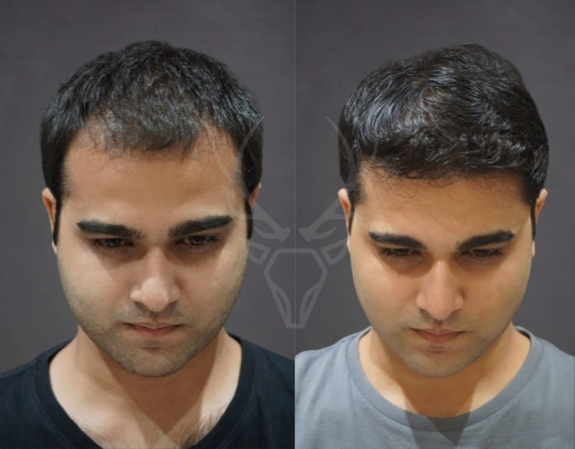Musk Clinic Hair Transplant Results - Before After Results 25