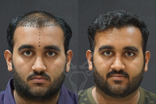 Musk Clinic Hair Transplant Results - Before After Results 26 Centre
