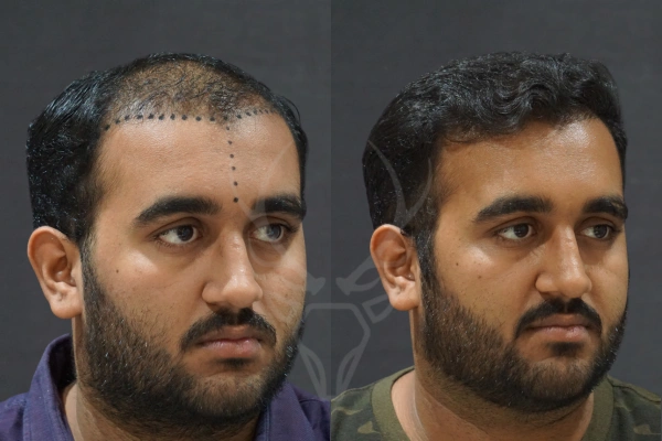 Musk Clinic Hair Transplant Results - Before After Results 26 Left