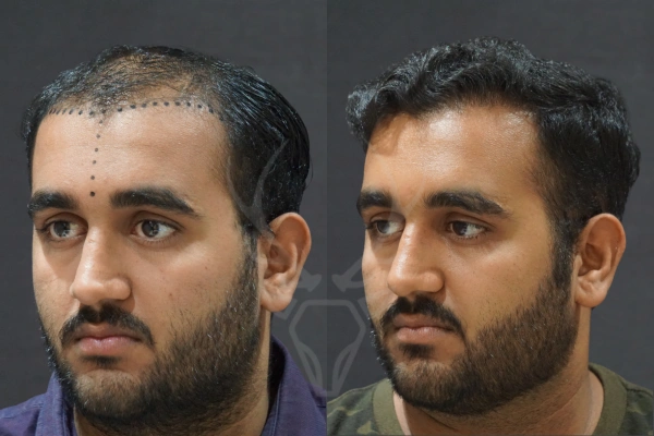 Musk Clinic Hair Transplant Results - Before After Results 26 Right