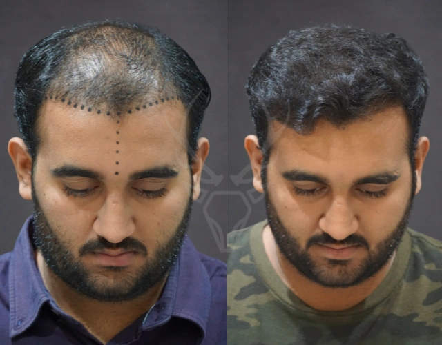 Musk Clinic Hair Transplant Results - Before After Results 26