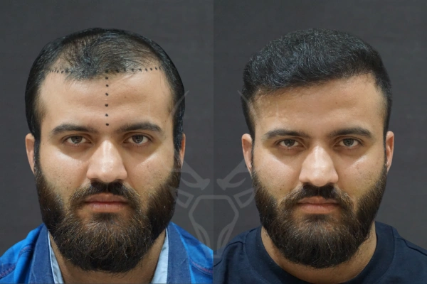 Musk Clinic Hair Transplant Results - Before After Results 27 Centre