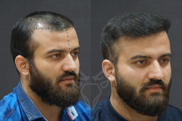 Musk Clinic Hair Transplant Results - Before After Results 27 Left