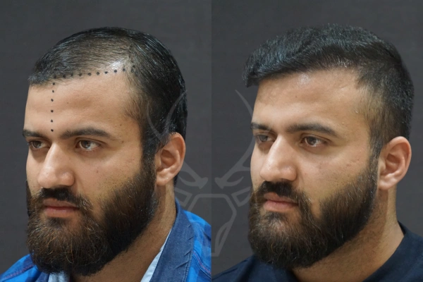 Musk Clinic Hair Transplant Results - Before After Results 27 Right