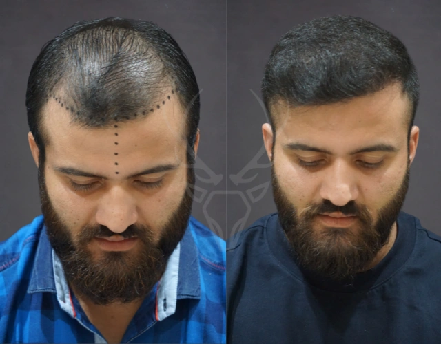 Musk Clinic Hair Transplant Results - Before After Results 27
