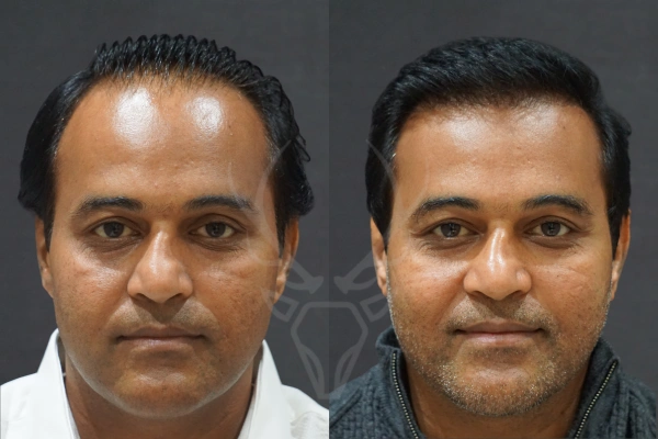 Musk Clinic Hair Transplant Results - Before After Results 28 Centre