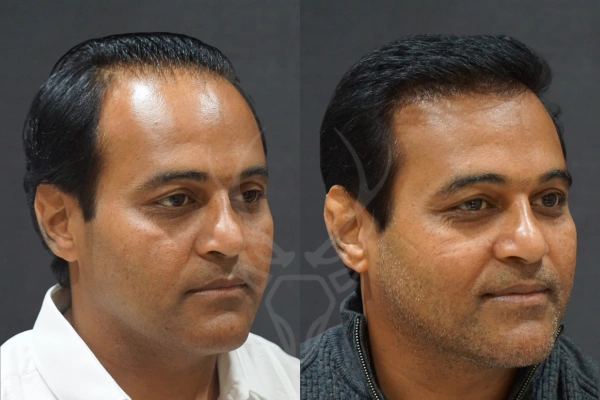 Musk Clinic Hair Transplant Results - Before After Results 28 Left