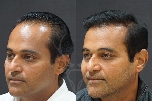 Musk Clinic Hair Transplant Results - Before After Results 28 Right